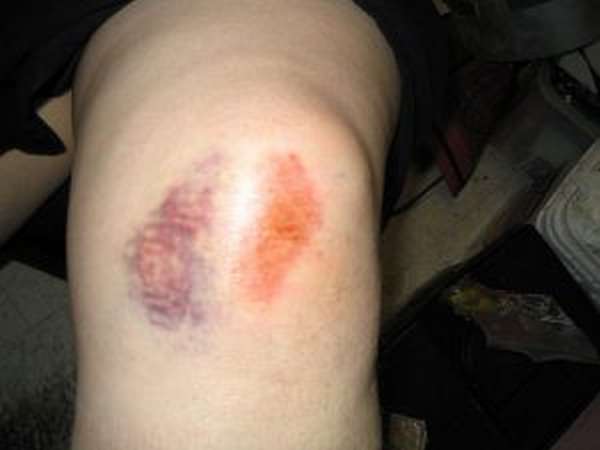 Травматические повреждения коленного сустава
